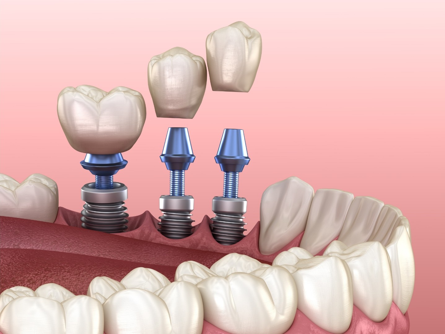 Implantologia dentale in unica seduta